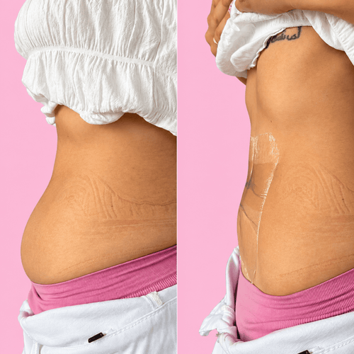 Cinta reafirmante abdominal