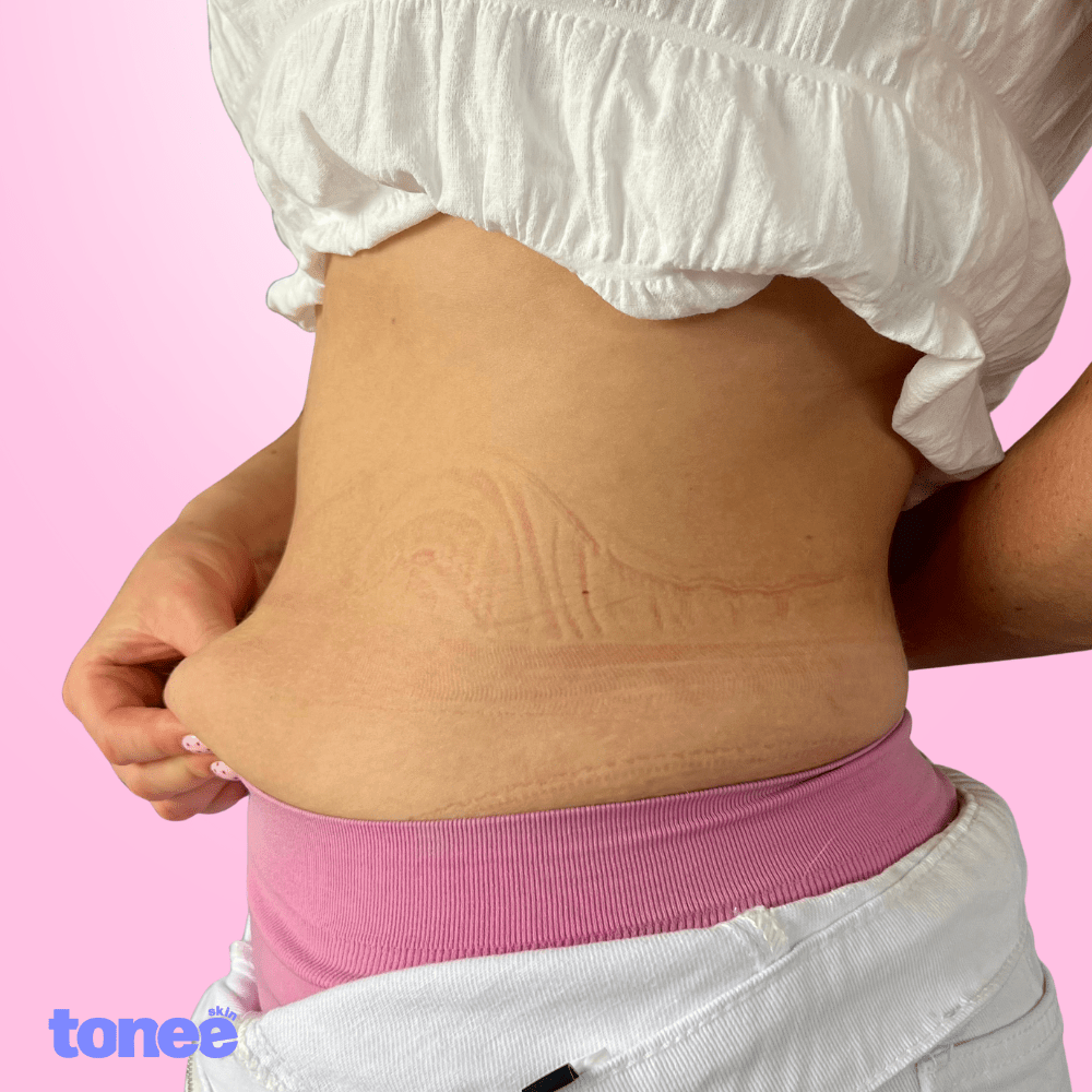 Cinta reafirmante abdominal